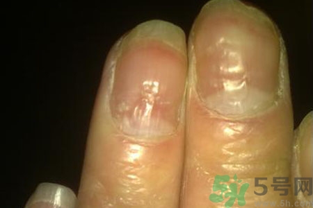 孩子手指甲凹凸不平是什么原因？手指甲凹凸不平的原因是什么？