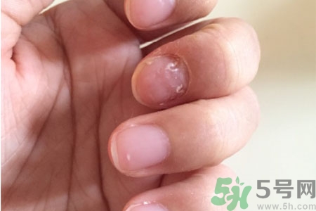 孩子手指甲凹凸不平是什么原因？手指甲凹凸不平的原因是什么？