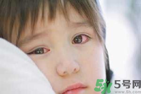 流行性腮腺炎的表現有哪些？?流行性腮腺炎飲食怎么調理？