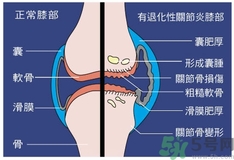 骨關節炎能治好嗎？骨關節炎平時注意事項
