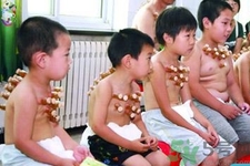 小孩可以拔罐嗎？寶寶能拔火罐嗎？