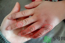 生凍瘡癢怎么辦？生凍瘡很癢的時候怎么辦？