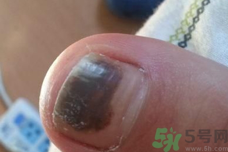 腳趾甲變黑是什么原因？腳趾甲變黑是怎么回事？