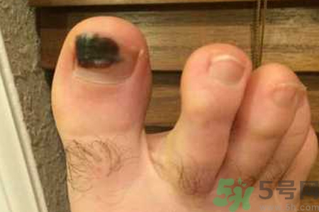 腳趾甲變黑是什么原因？腳趾甲變黑是怎么回事？
