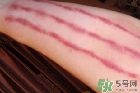 揪痧和刮痧哪個效果比較好？揪痧和刮痧的區別？