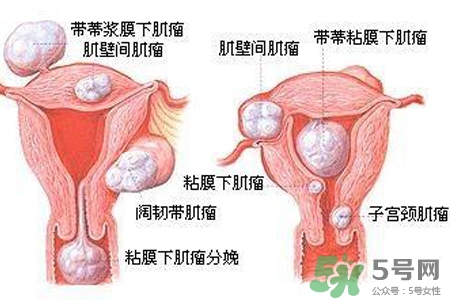 子宮小會影響生育嗎？子宮小會導致不孕嗎？