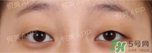 埋線雙眼皮多久恢復(fù)自然？埋線雙眼皮多久能恢復(fù)