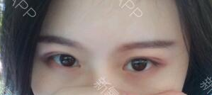 定點雙眼皮能保持多久？定點雙眼皮是永久的嗎？