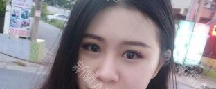 定點雙眼皮能保持多久？定點雙眼皮是永久的嗎？