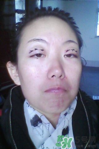 什么是定點雙眼皮？定點雙眼皮多少錢？