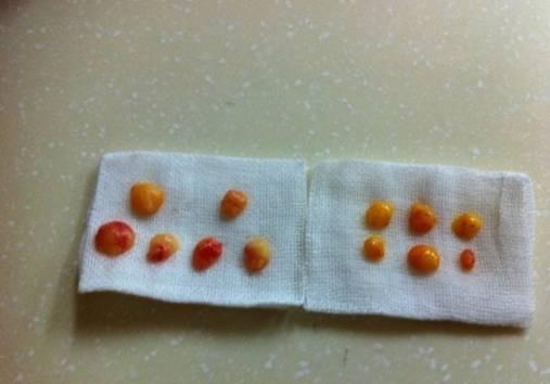 韓式三點雙眼皮是永久嗎？三點雙眼皮能保持多久？
