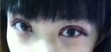 韓式三點雙眼皮是永久嗎？三點雙眼皮能保持多久？