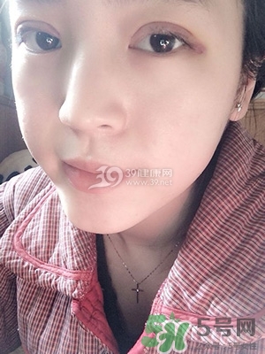 什么是定點雙眼皮？定點雙眼皮多少錢？