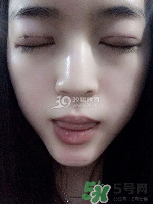 什么是定點雙眼皮？定點雙眼皮多少錢？