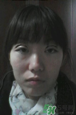 什么是定點雙眼皮？定點雙眼皮多少錢？