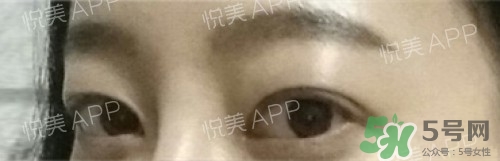 埋線雙眼皮多久恢復(fù)自然？埋線雙眼皮多久能恢復(fù)