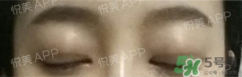 埋線雙眼皮多久恢復(fù)自然？埋線雙眼皮多久能恢復(fù)