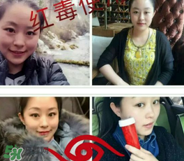 美國(guó)紅毒溶脂怎么樣？美國(guó)紅毒溶脂有用嗎？