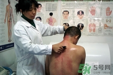 刮痧可以減肥嗎？刮痧減肥有效果嗎？