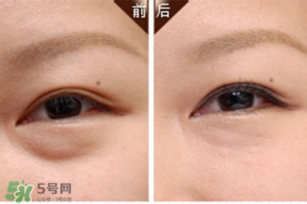 臥蠶是黑眼圈嗎？臥蠶和黑眼圈的區別