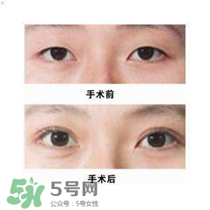 割雙眼皮疼不疼？割雙眼皮疼幾天能好？