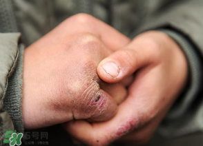 三月份還長凍瘡嗎？三月份凍瘡沒好怎么辦？
