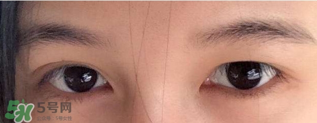 眼睛發黃是怎么回事？眼睛發黃是什么原因