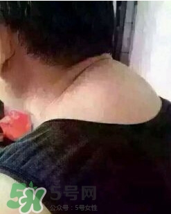 刮痧之后可以艾灸嗎？刮痧之后可不可以艾灸