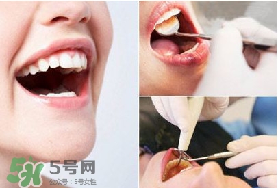 如何去掉牙結石？牙結石怎么去除