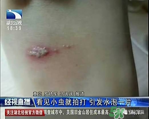 隱翅蟲有毒嗎？隱翅蟲會毀容嗎？