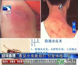 隱翅蟲有毒嗎？隱翅蟲會毀容嗎？