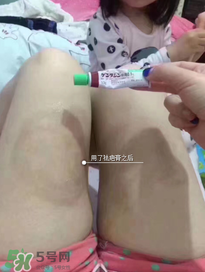 日本msd祛疤膏怎么樣？日本msd祛疤膏有用嗎？