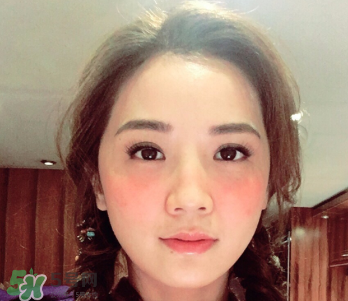 夏天可以點痣嗎？夏天點痣后要注意什么？