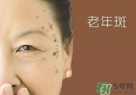 老年斑多大年齡開(kāi)始有？為什么牙膏能去老年斑？