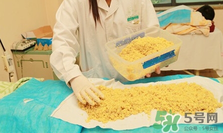 隔姜灸效果怎么樣？隔姜灸好還是直接灸好