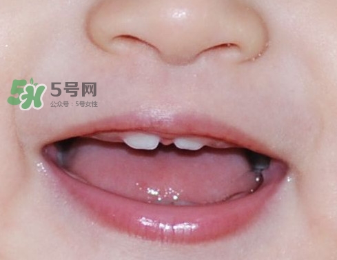 牙齒縫隙大怎么辦？牙縫大帶牙套有用嗎