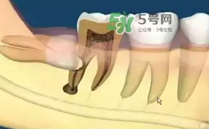 智齒是每個人都會長嗎？拔智齒能瘦臉嗎？