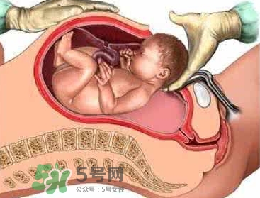 剖腹產(chǎn)比順產(chǎn)安全嗎？剖腹產(chǎn)產(chǎn)后注意事項(xiàng)？