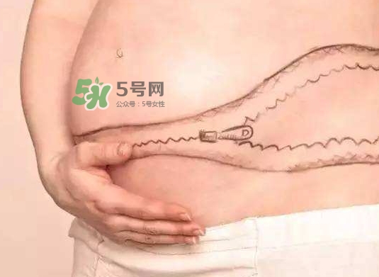 剖腹產疤痕怎么去除？剖腹產疤痕能去掉嗎？