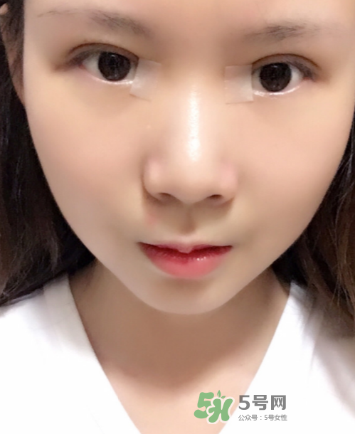 美皮護去疤效果怎么樣？美皮護有用嗎？