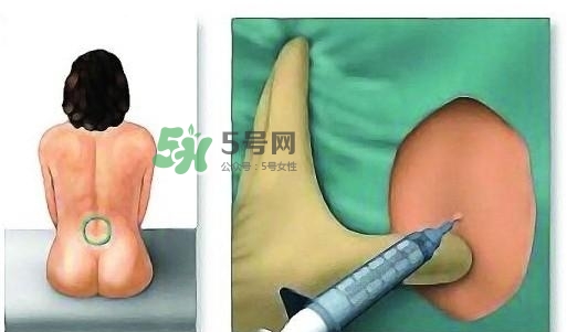 無痛分娩為什么不提倡？無痛分娩有后遺癥嗎？