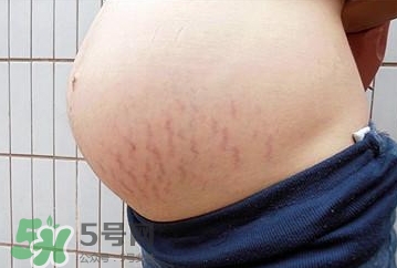 妊娠紋什么時候開始預防？妊娠紋什么時候消除？