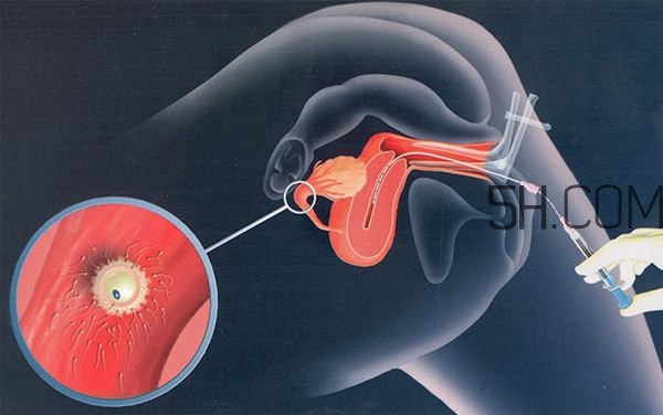 人工授精取卵子怎么?。咳斯な诰腥嗽鯓尤【?？