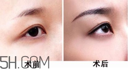 切眉手術(shù)后老得快嗎？切眉能保持多久？