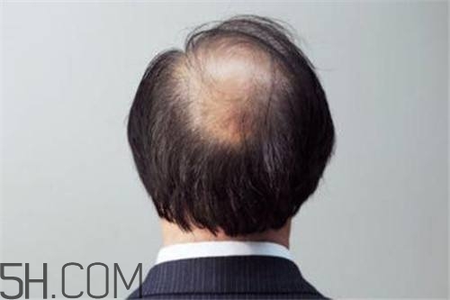 為什么男性比女性更容易脫發(fā)？什么原因?qū)е履行悦摪l(fā)？