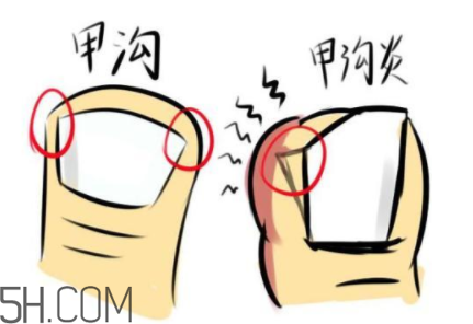 為什么容易得甲溝炎？怎么根治甲溝炎？