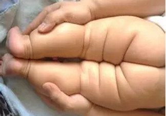 寶寶腿紋不對稱是怎么回事？嬰幼兒的生長發育標準是怎樣的？