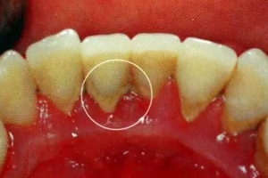 牙結石能自動脫落嗎？除了洗牙別無他法