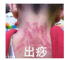 吮痧有什么療效？最溫柔的治病方法