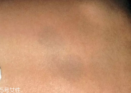 痣什么情況下會轉變為瘤？點痣不可取